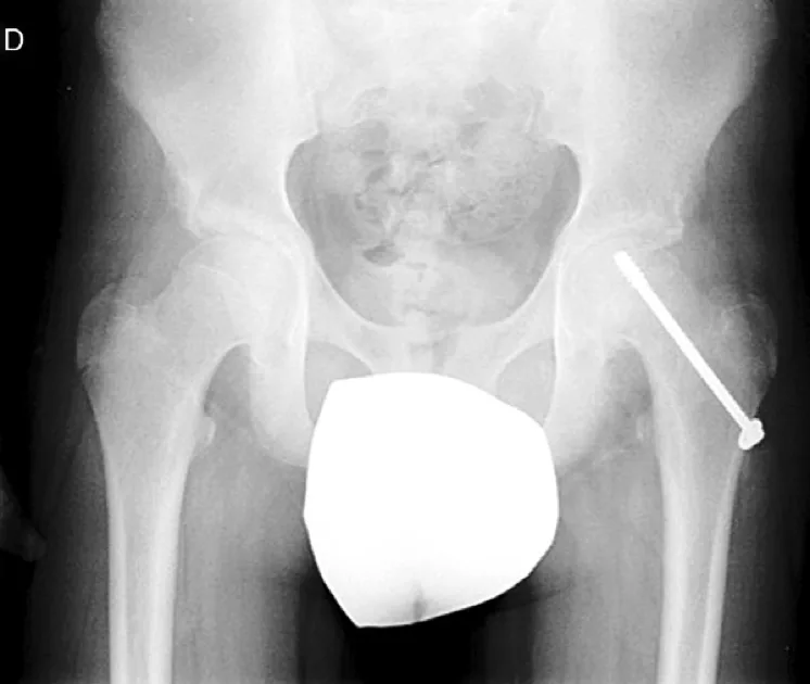 Epifisiolisis-Cabeza-Femoral5