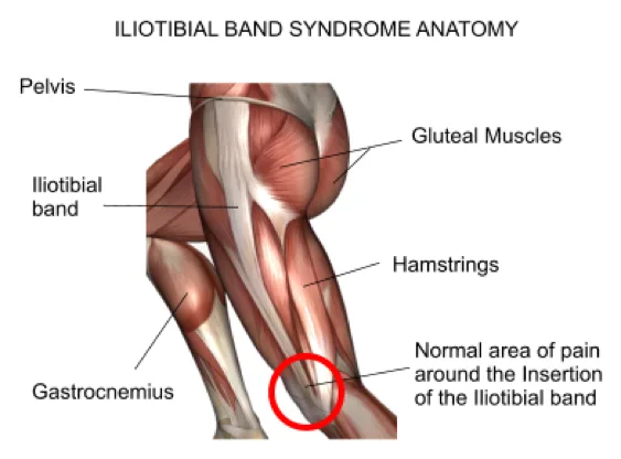 SÍndrome de Fricción de la Banda Iliotibial