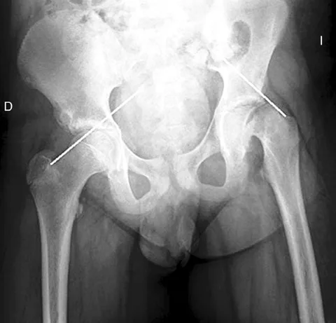 Epifisiolisis-Cabeza-Femoral2