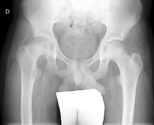 Epifisiolisis-Cabeza-Femoral1
