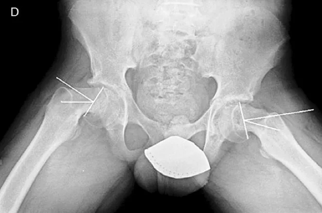 Epifisiolisis-Cabeza-Femoral4