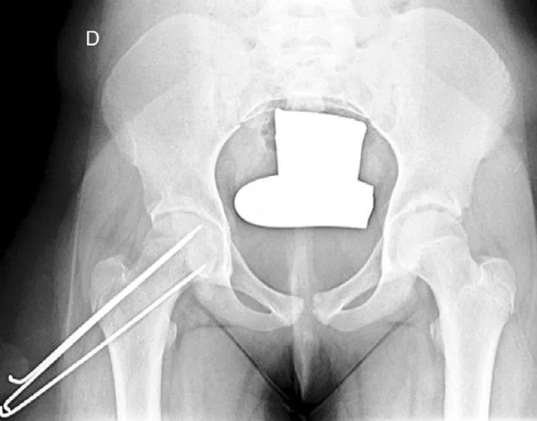 Epifisiolisis-Cabeza-Femoral6